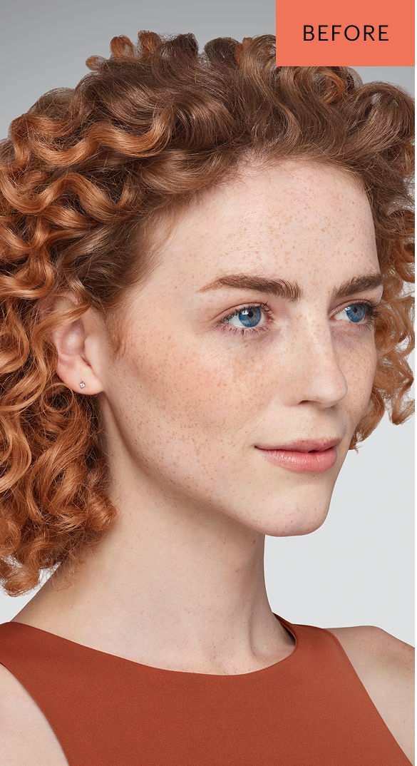 ADDIESON - cheeks, chin, undereye & lips Before Juvederm