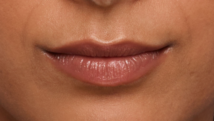 before and after photo of a woman using Juvederm for fuller natural lips