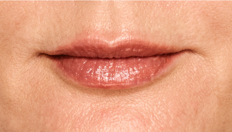 before and after photo of a woman using Juvederm for fuller natural lips