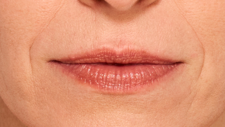 before and after photo of a woman using Juvederm