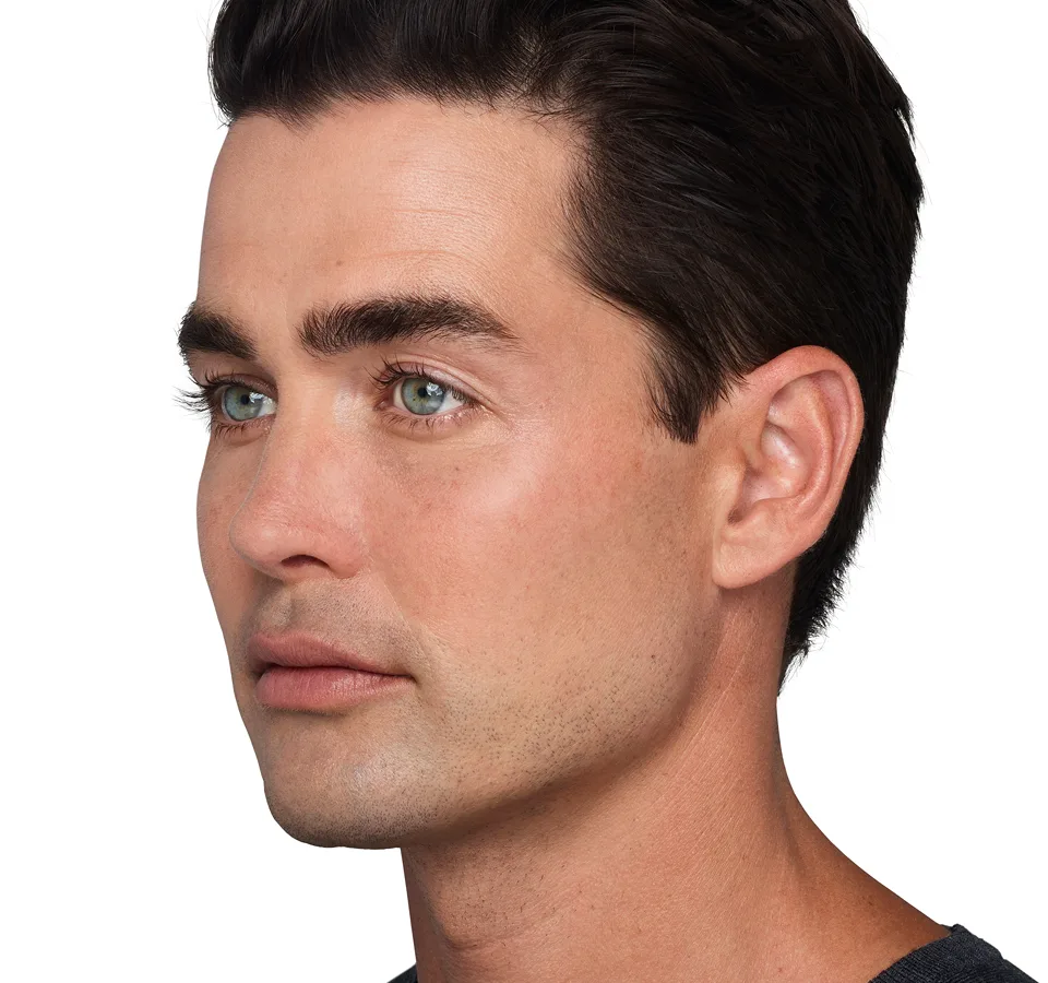 Headshot Sterling- Juvederm Customize After 2