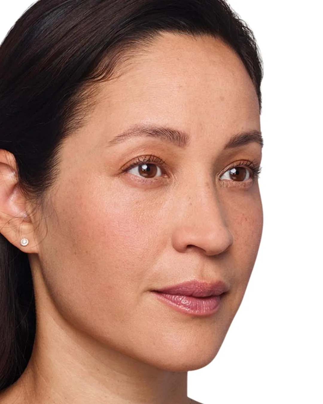 Headshot Cherub - Juvederm After 1 syringe in the cheeks After 1