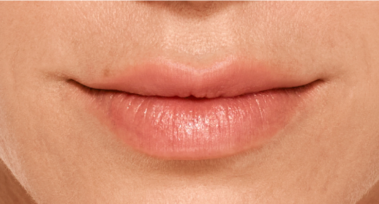 before and after photo of a woman using Juvederm for fuller natural lips