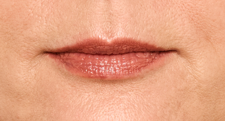 before and after photo of a woman using Juvederm for fuller natural lips