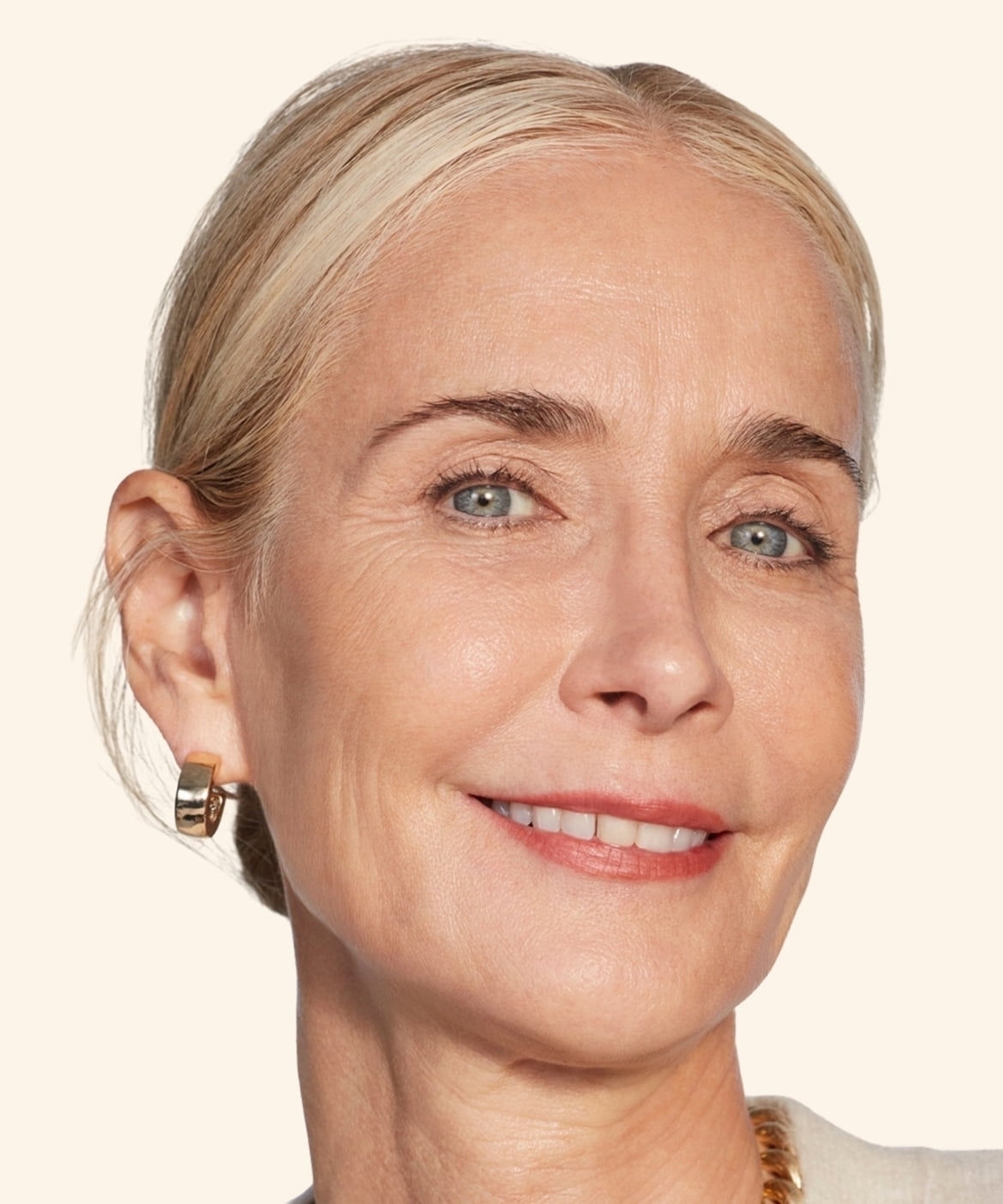 Juvederm Treatment Areas