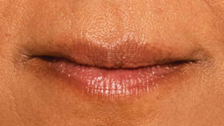 before and after photo of a woman using Juvederm for fuller natural lips