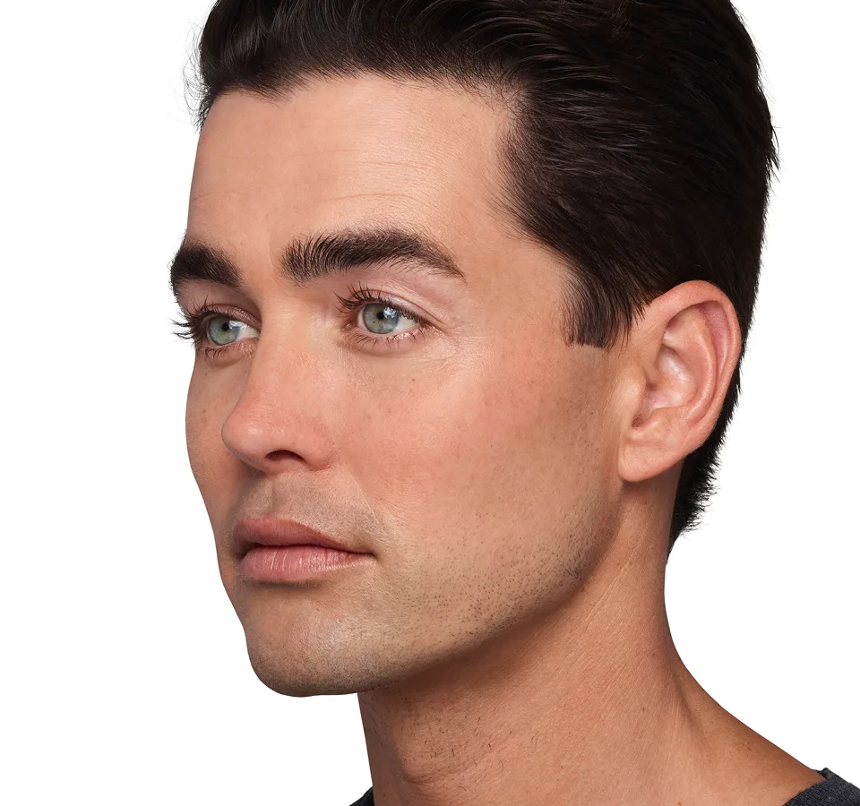 Headshot Sterling- Juvederm Optimize After 1