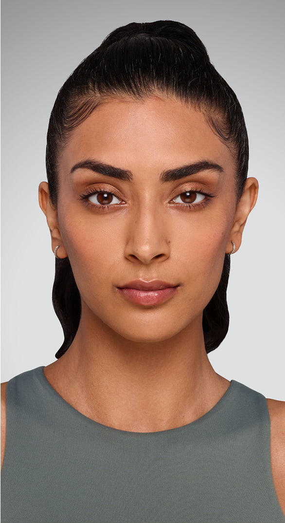 Undereyes - After Juvederm