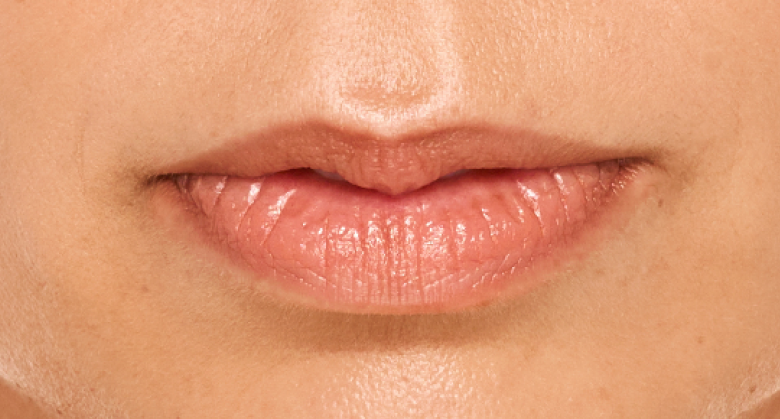 before and after photo of a woman using Juvederm for fuller natural lips