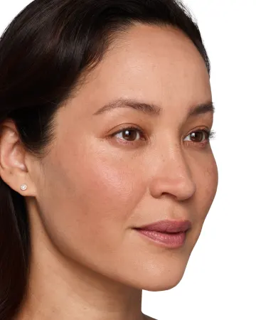 Headshot Cherub - Juvederm Optimize After 2