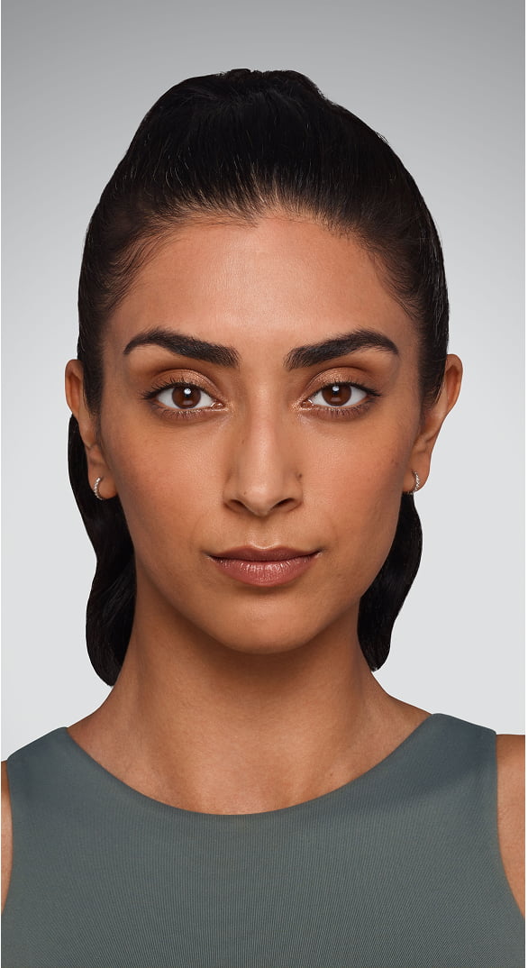 Undereyes - Before Juvederm