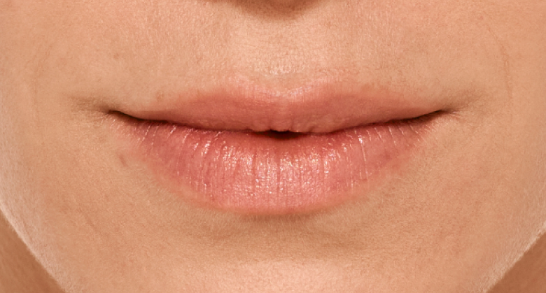before and after photo of a woman using Juvederm for fuller natural lips
