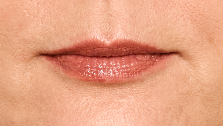 before and after photo of a woman using Juvederm for fuller natural lips