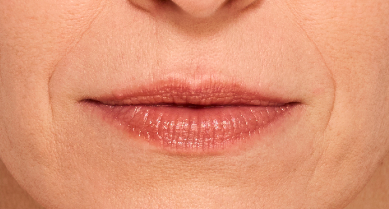 before and after photo of a woman using Juvederm