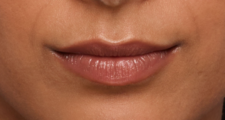 before and after photo of a woman using Juvederm for fuller natural lips