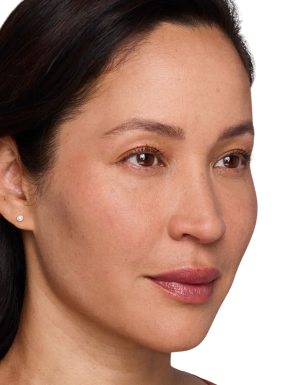 Headshot Cherub - Juvederm Customize After 3