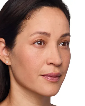 Headshot Cherub - Juvederm Before