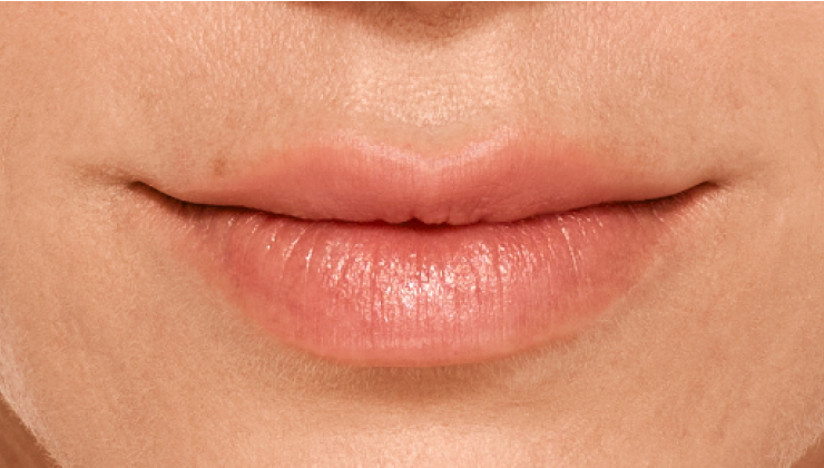 before and after photo of a woman using Juvederm for fuller natural lips