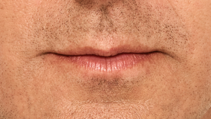 before and after photo of a man using Juvederm for fuller natural lips