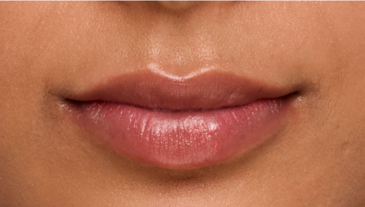 before and after photo of a woman using Juvederm for fuller natural lips