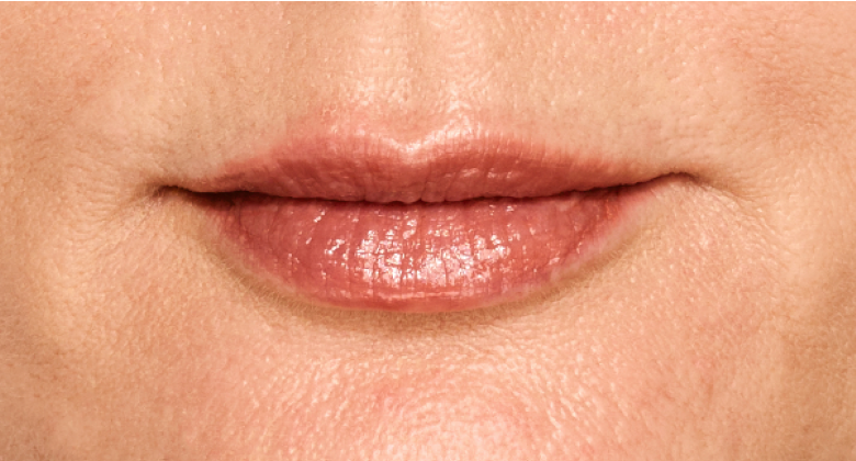 before and after photo of a woman using Juvederm for fuller natural lips