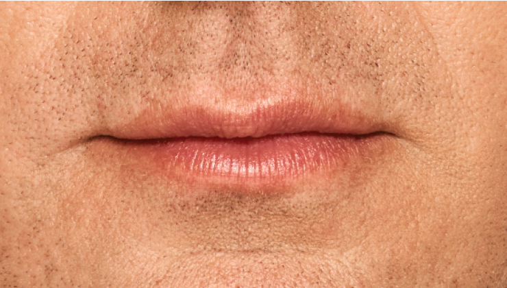 before and after photo of a man using Juvederm for fuller natural lips