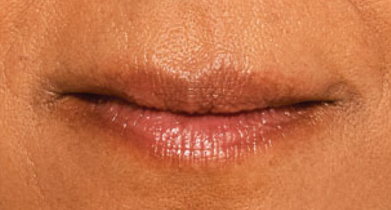 before and after photo of a woman using Juvederm for fuller natural lips