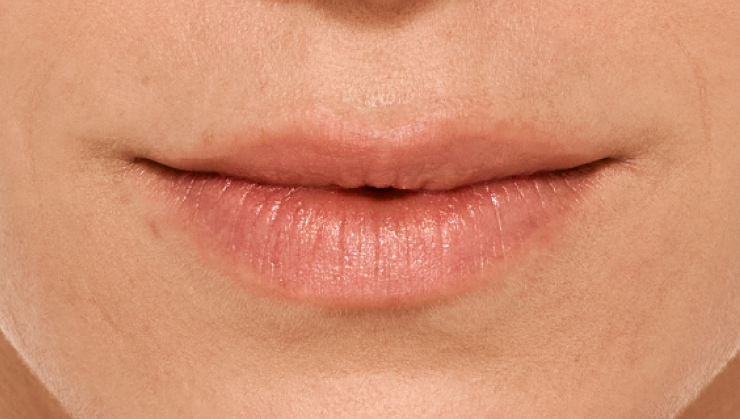 before and after photo of a woman using Juvederm for fuller natural lips