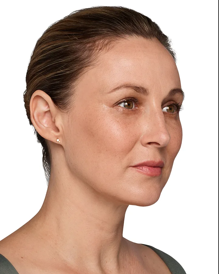 Headshot Kate - Juvederm Optimize After 2