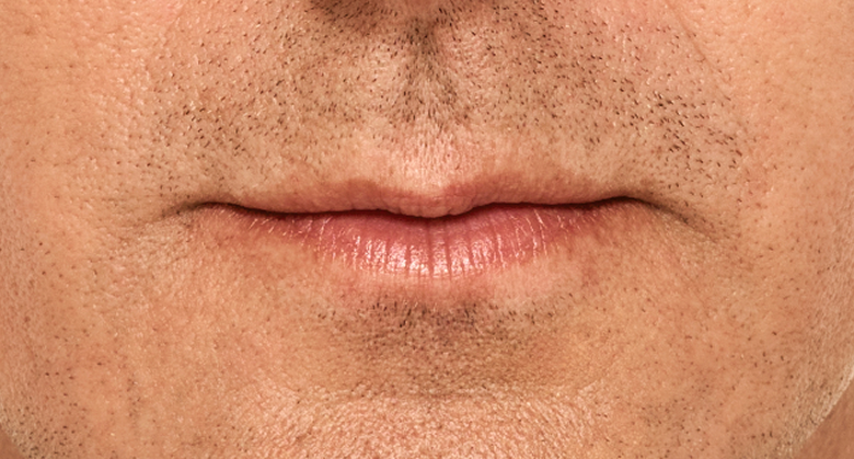 before and after photo of a man using Juvederm for fuller natural lips
