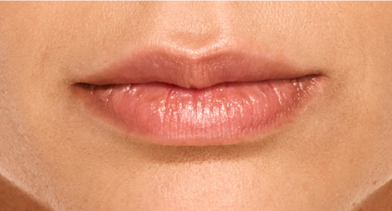 before and after photo of a woman using Juvederm for fuller natural lips
