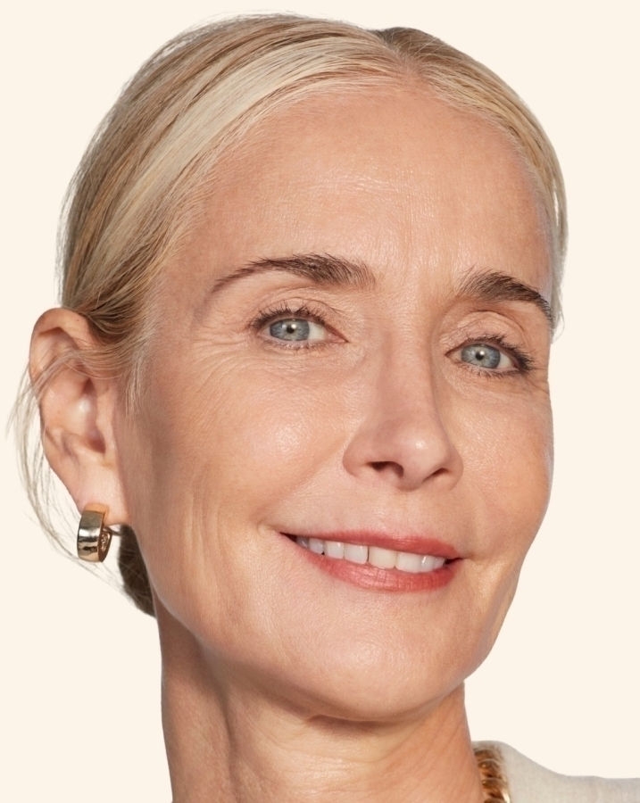 Juvederm Treatment Areas