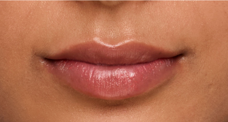 before and after photo of a woman using Juvederm for fuller natural lips