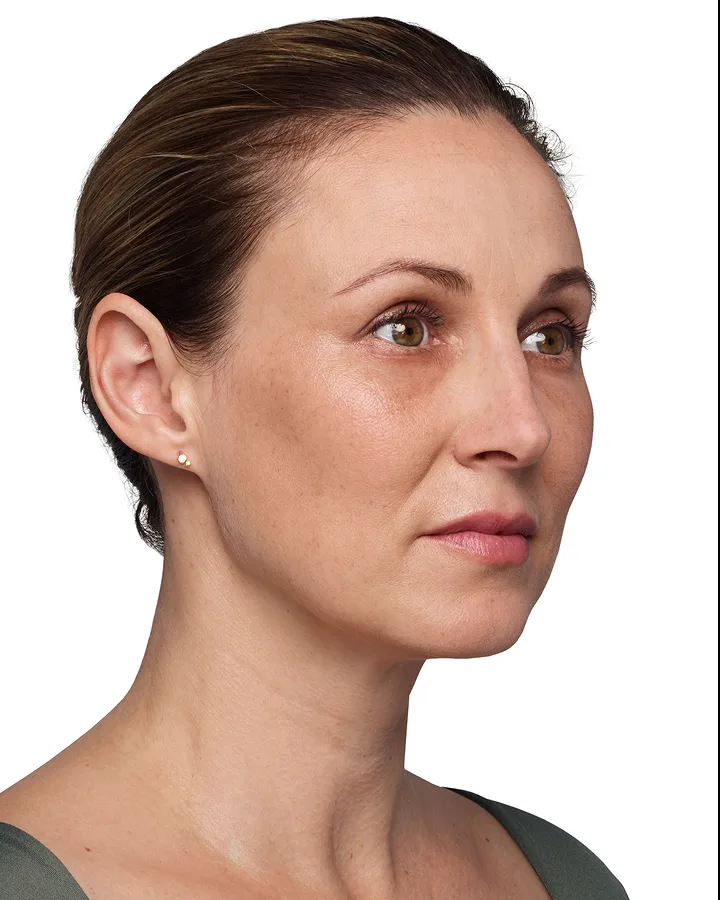 Headshot Kate - Juvederm Before
