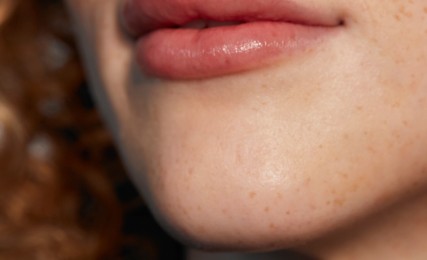 Juvederm Treatment Areas