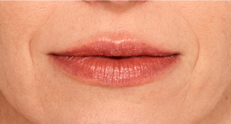 before and after photo of a woman using Juvederm