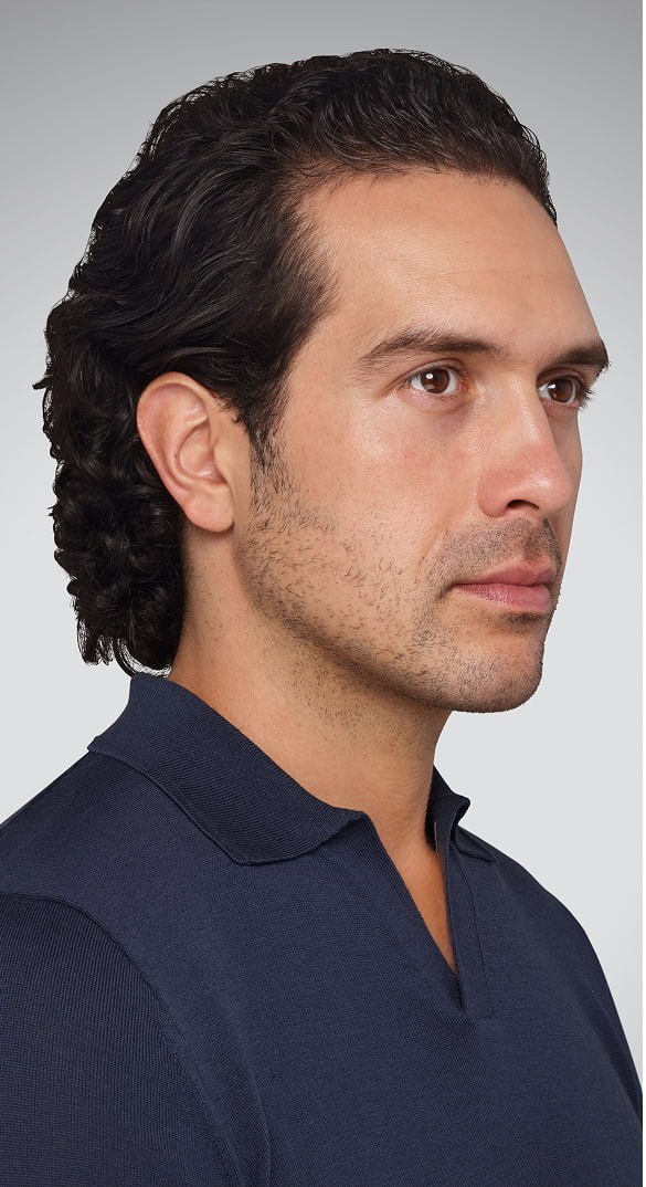 DEVIN - cheeks, lips, undereye, lines & jawline Before Juvederm