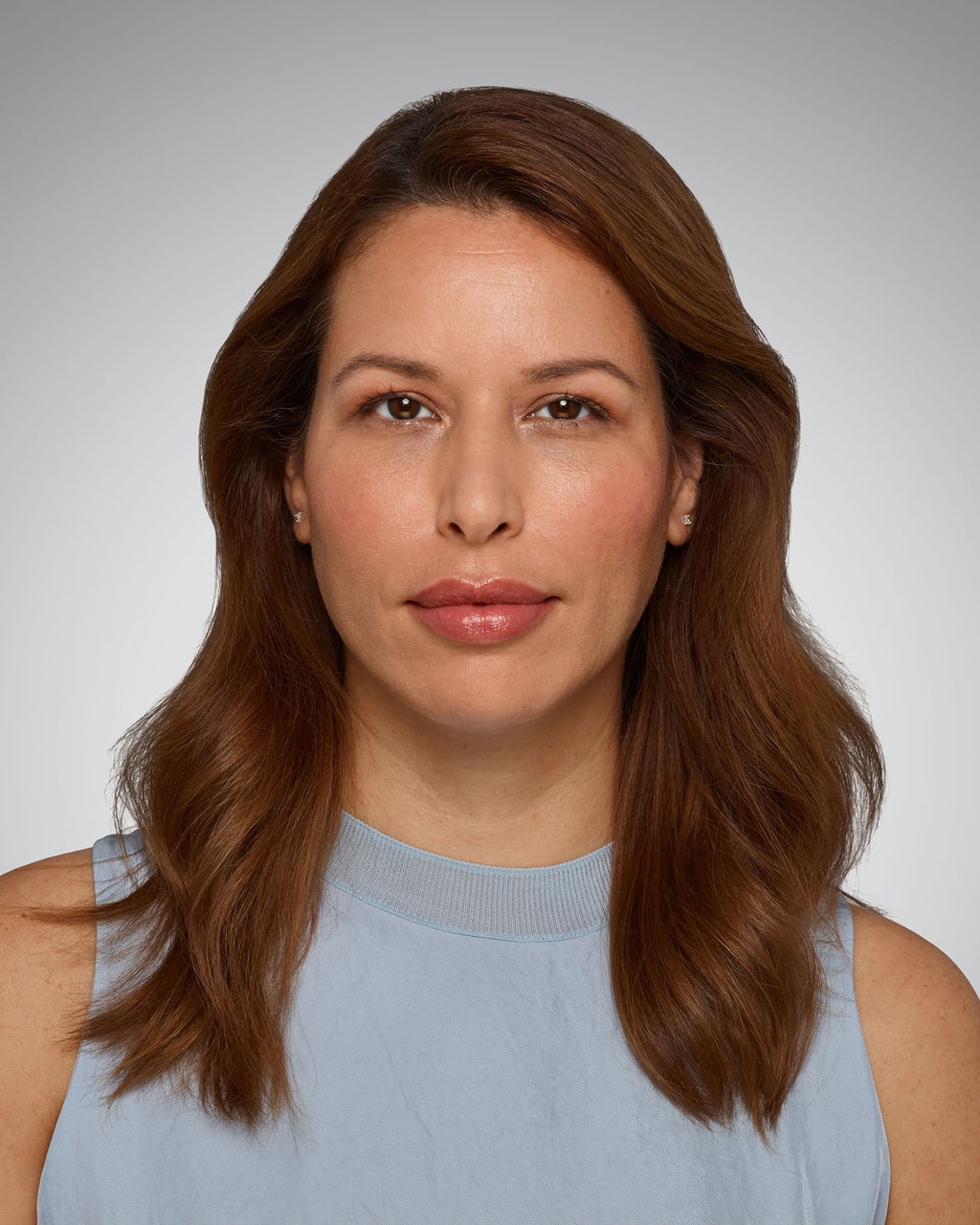 Lines - After Juvederm