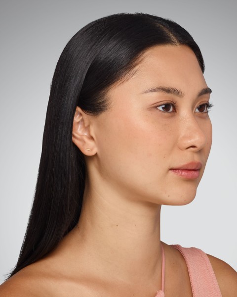 SARA - cheeks, undereye, lips & jawline Before Juvederm