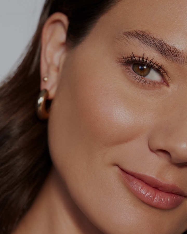 Victoria-Juvederm Results 