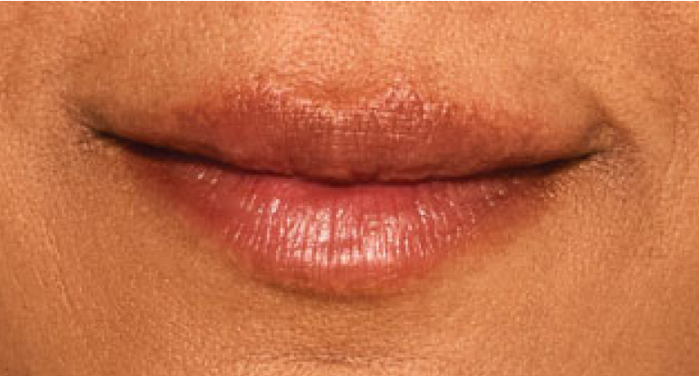 before and after photo of a woman using Juvederm for fuller natural lips