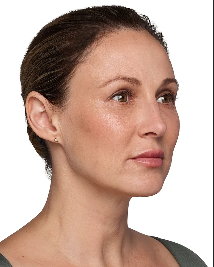 Headshot Kate - Juvederm Customize After 3