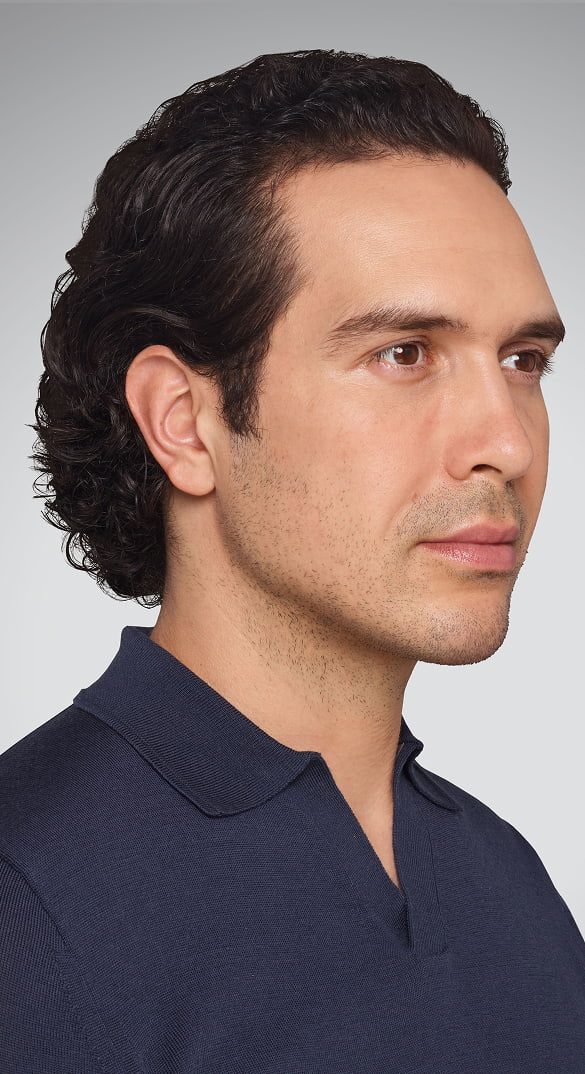 DEVIN - cheeks, lips, undereye, lines & jawline After Juvederm