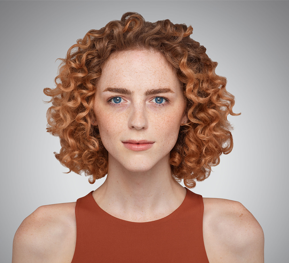 addieson - cheeks, chin, undereye & lips Before Juvederm