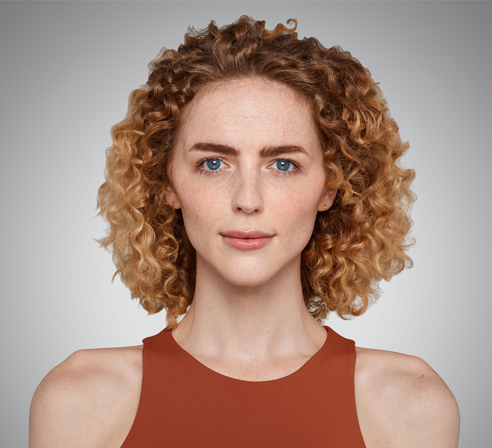 addieson - cheeks, chin, undereye & lips After Juvederm
