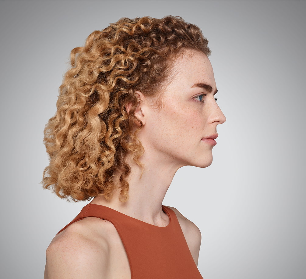 addieson - cheeks, chin, undereye & lips After Juvederm
