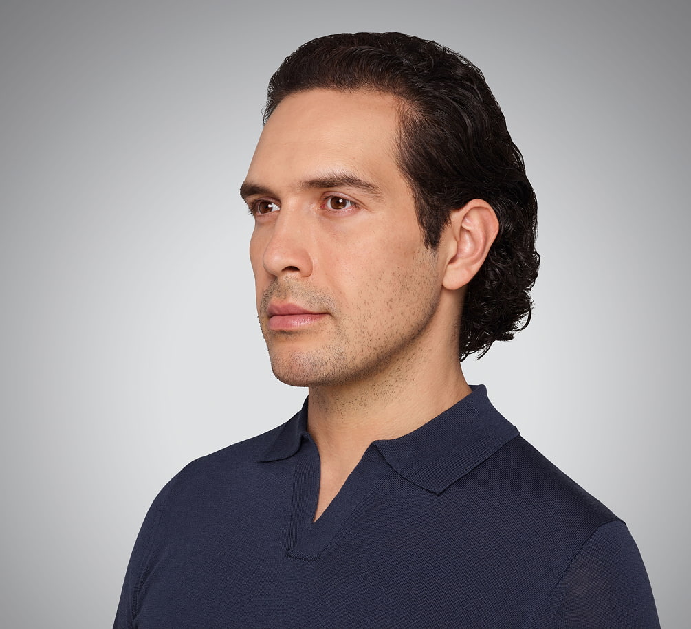 devin - cheeks, lips, undereye, lines & jawline After Juvederm