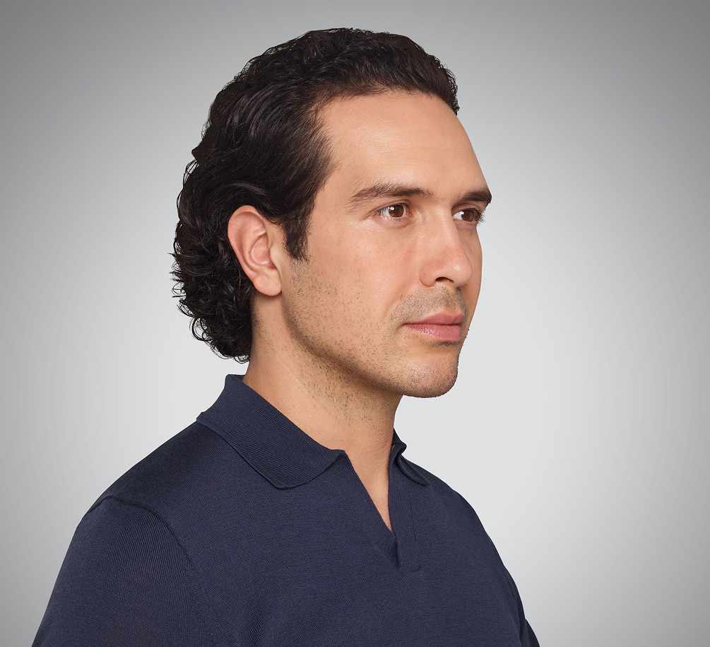 devin - cheeks, lips, undereye, lines & jawline After Juvederm