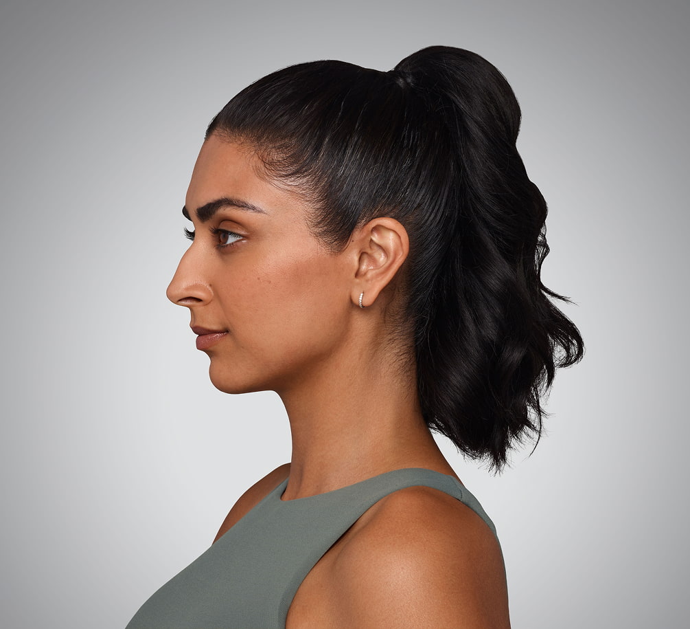 JASKIRAN - cheeks, chin, undereye, lines & lips Before Juvederm