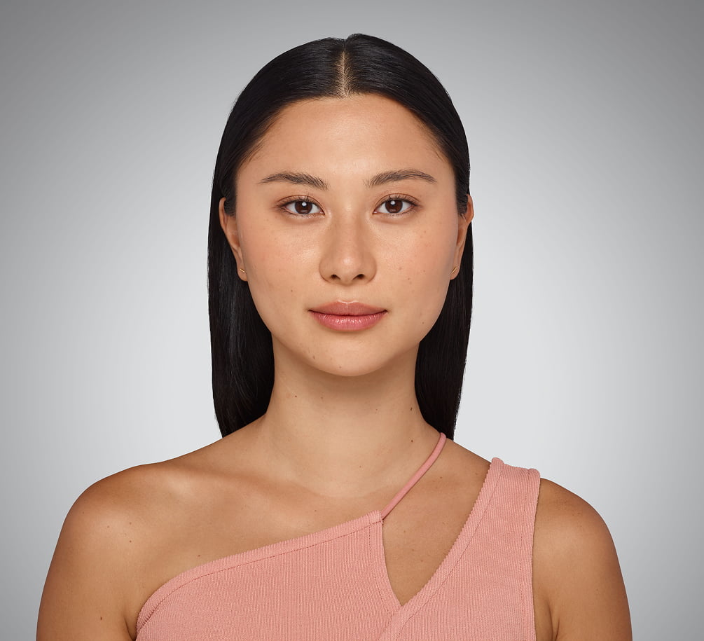 sara - cheeks, undereye, lips & jawline Before Juvederm